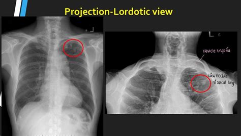 for apicolordotic view